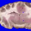 5D3 Holoprosencephaly, partial (Case 5)_15A