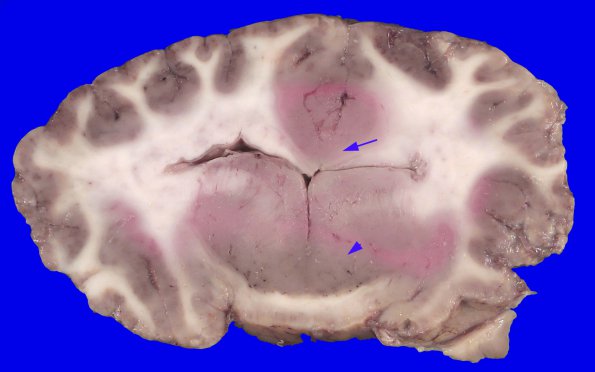 5D3 Holoprosencephaly, partial (Case 5)_15A