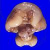 6A1 Holoprosencephaly (Case 6) 6A