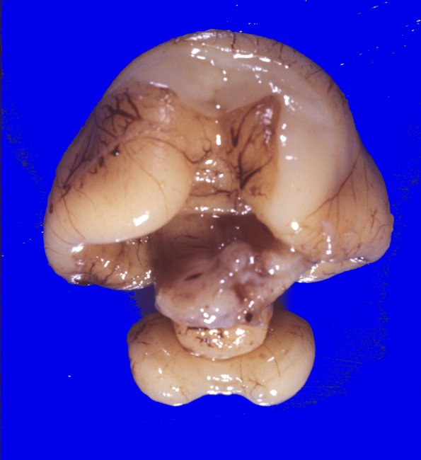 6A1 Holoprosencephaly (Case 6) 6A