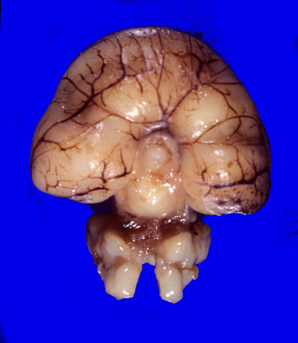 6A2 Holoprosencephaly (Case 6) 5A