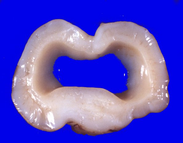 6A3 Holoprosencephaly (Case 6) 3 - CopyA