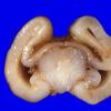 6A4 Holoprosencephaly (Case 6) 4 - CopyA