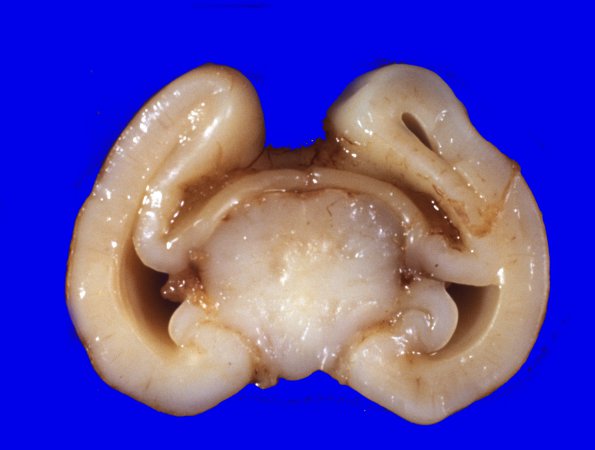 6A4 Holoprosencephaly (Case 6) 4 - CopyA