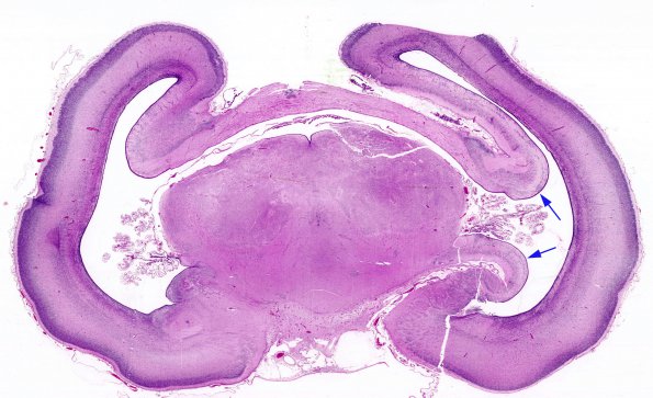 6B1 Holoprosencephaly (Case 6) 5 H&E whole mount 2