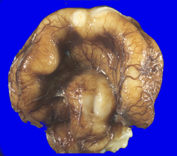 7A1 Holoprosencephaly, semilobar (Case 7) 11 - CopyA