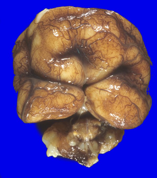 7A2 Holoprosencephaly, semilobar (Case 7) 10 - CopyA