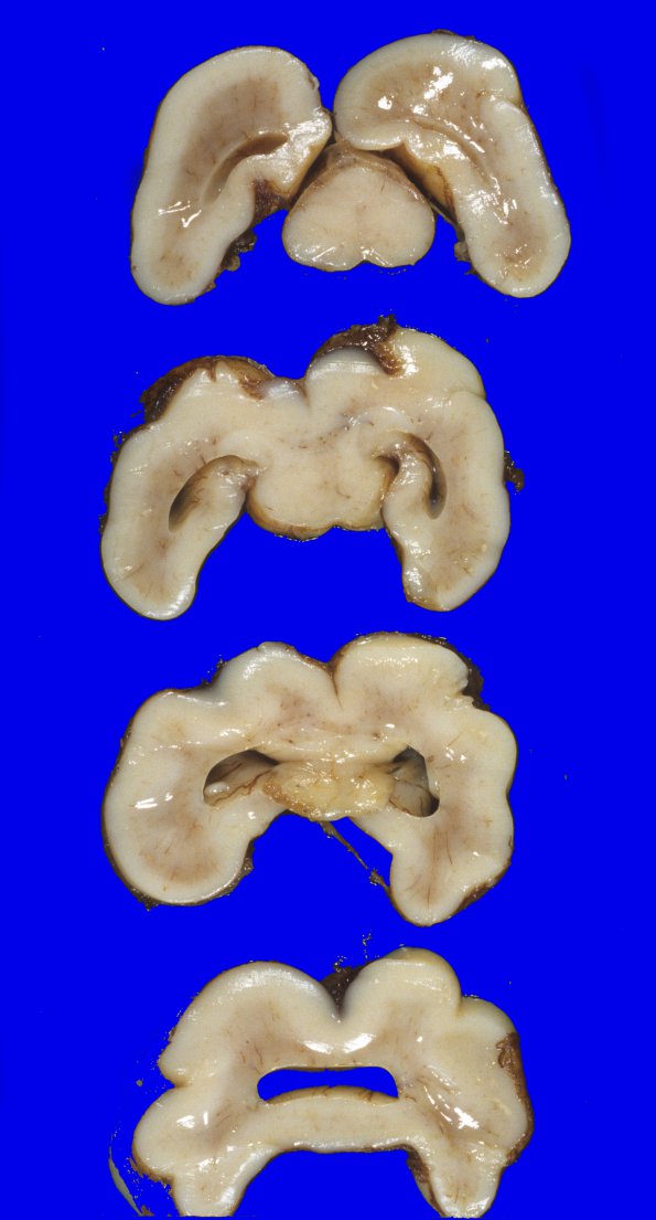 7A3 Holoprosencephaly, semilobar (Case 7) 7 - CopyA