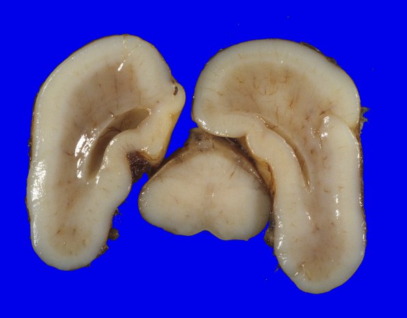 7A4 Holoprosencephaly, semilobar (Case 7) 9 - CopyA