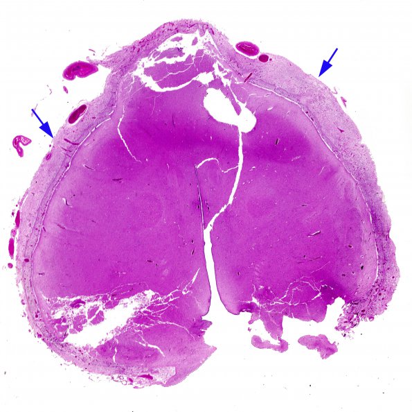 7B1 Holoprosencephaly & Heterotopia Leptomeningeal Glioneuronal (Case 7) B