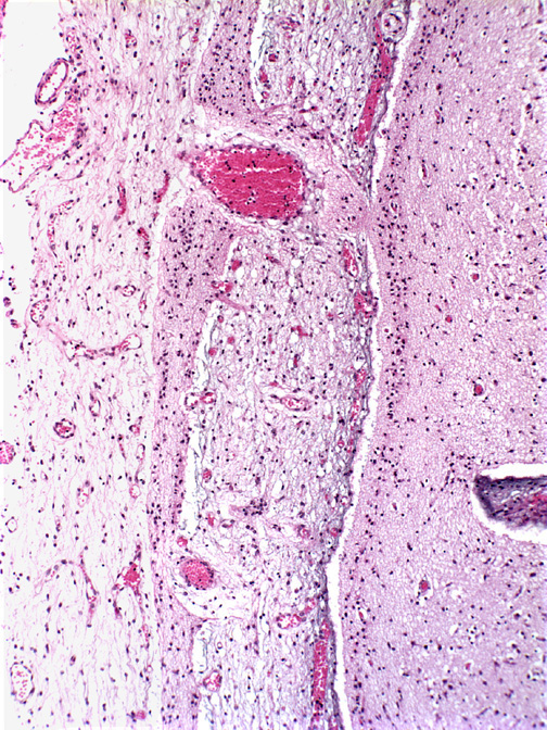 7B2 Holoprosencephaly & Heterotopia Leptomeningeal Glioneuronal (Case 7) A