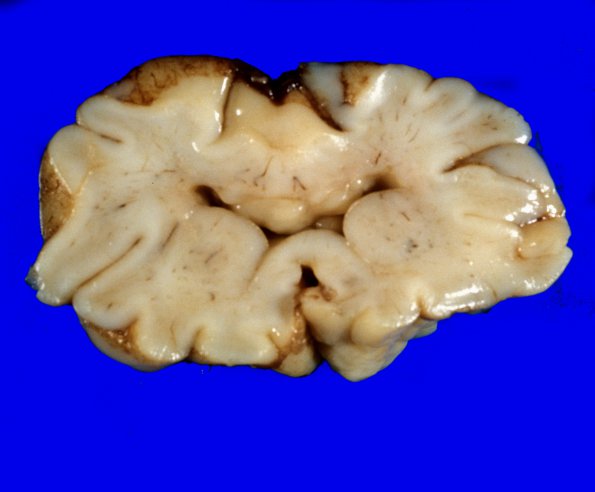 8B Holoprosencephaly (Case 8) gross1a - CopyA