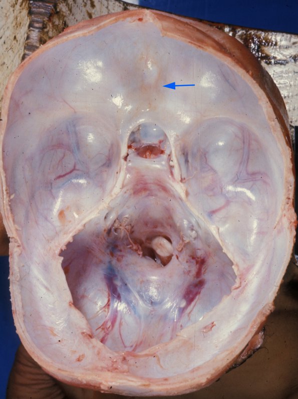 9A Holoprosencephaly (Case 9) 1AA