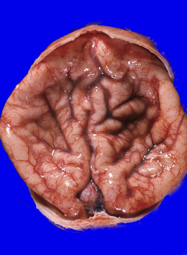 9B1 Holoprosencephaly (Case 9) 1 - CopyA