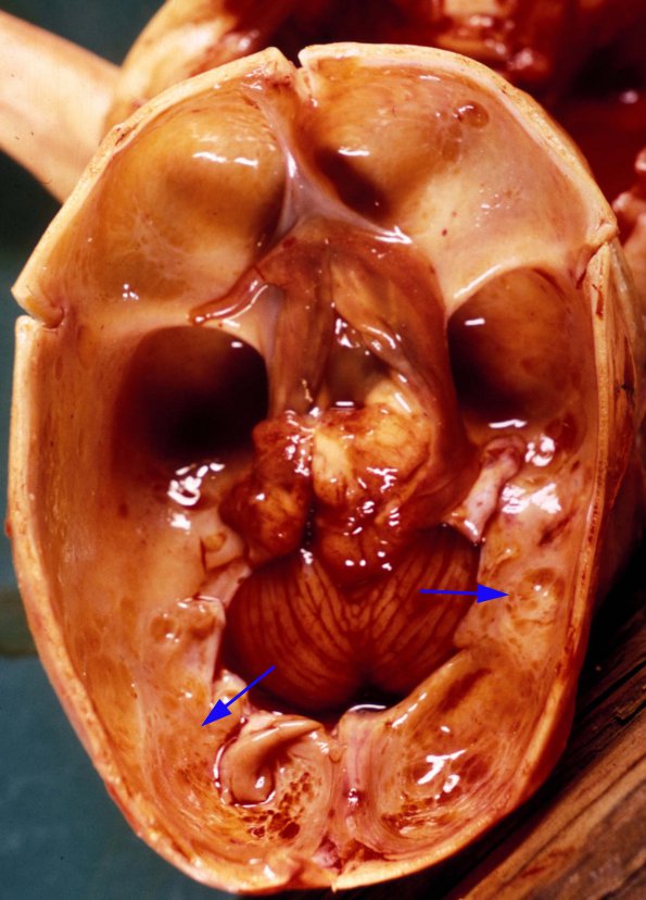 1A Hydranencephaly (Case 1) 1A