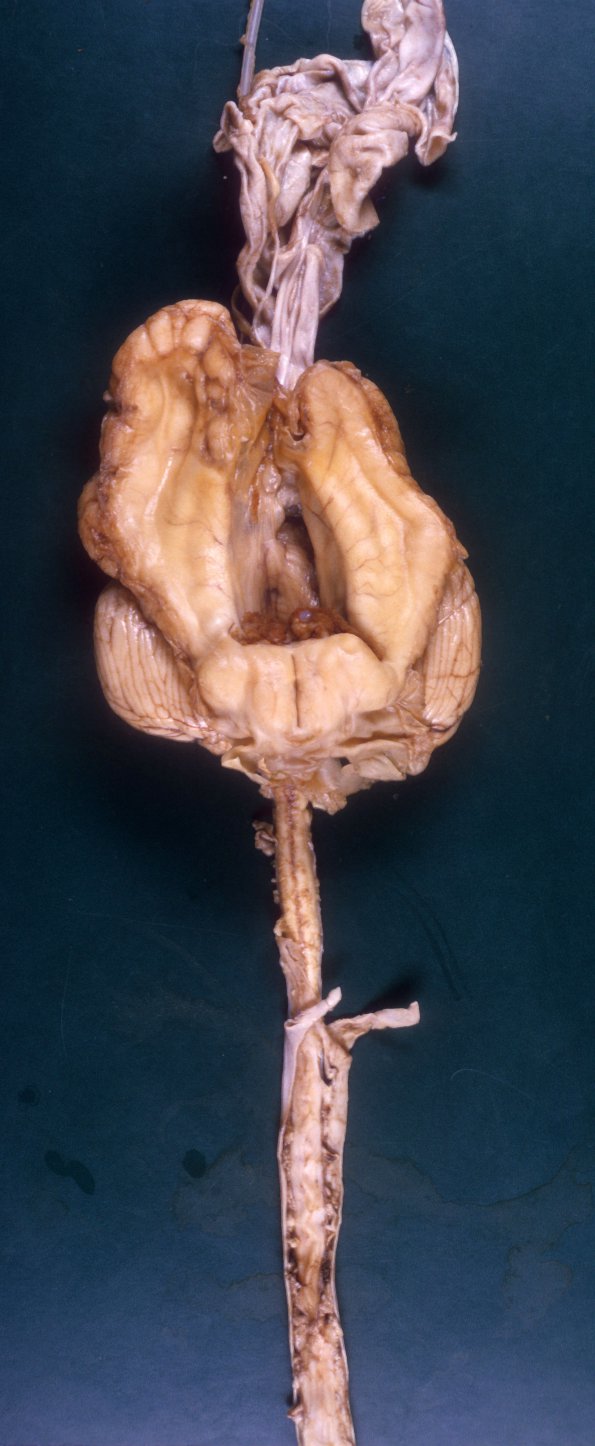 2A1 Hydranencephaly (Case 2) A3