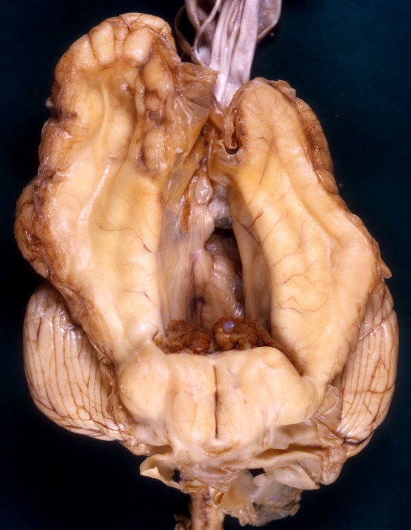 2A2 Hydranencephaly (Case 2) A2