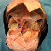 3A1 Hydranencephaly (Case 3) 1