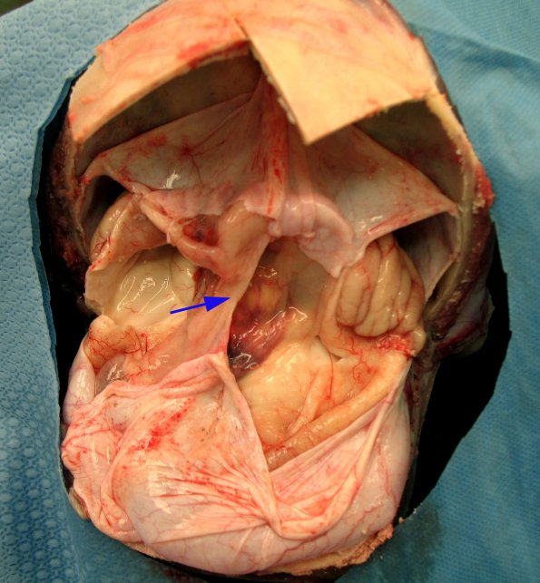 3A1 Hydranencephaly (Case 3) 1