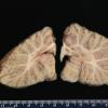 3A10  Hydranencephaly (Case 3) 13