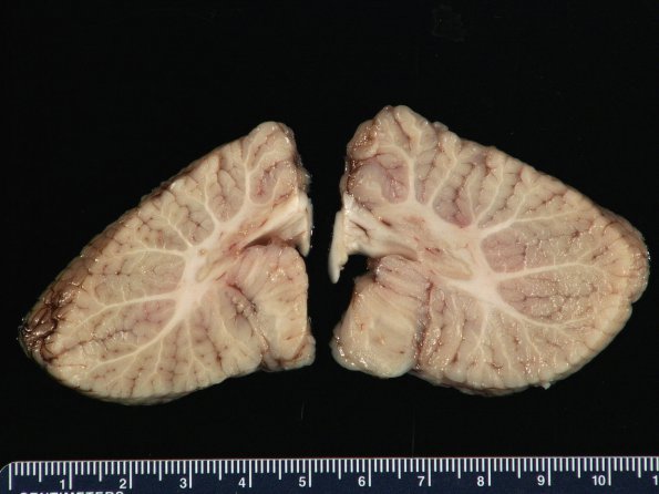 3A10  Hydranencephaly (Case 3) 13