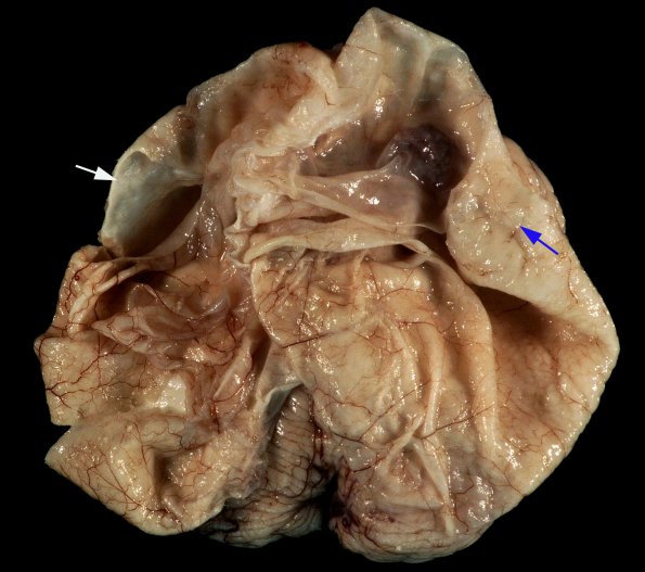 3A2 Hydranencephaly, Polymicrogyria (Case 3) _1A