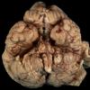 3A3 Hydranencephaly, Polymicrogyria (Case 3) _2