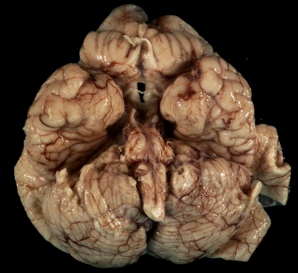 3A3 Hydranencephaly, Polymicrogyria (Case 3) _2