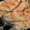 3A4 Hydranencephaly, Polymicrogyria (Case 3) _18A