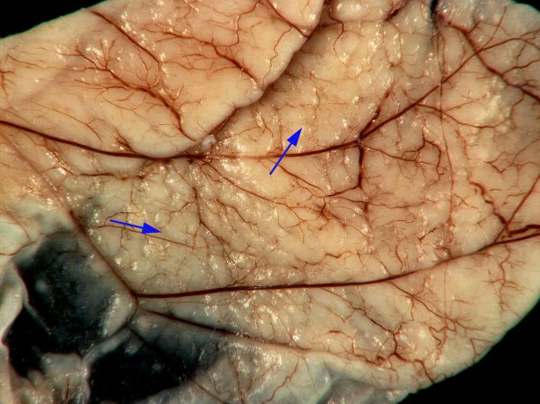 3A4 Hydranencephaly, Polymicrogyria (Case 3) _18A