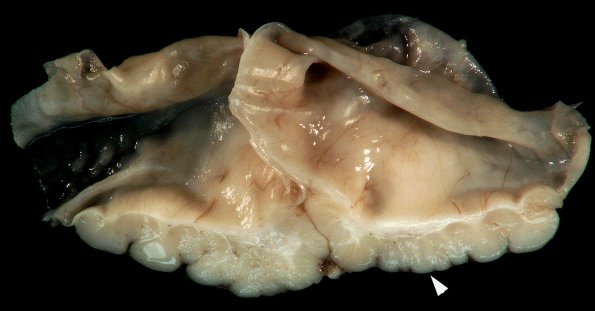 3A5 Hydranencephaly, Polymicrogyria (Case 3) _3A