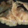 3A6 Hydranencephaly, Polymicrogyria (Case 3) _15