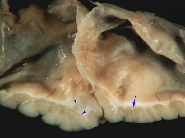 3A6 Hydranencephaly, Polymicrogyria (Case 3) _15