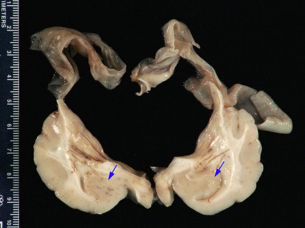 3A7 Hydranencephaly (Case 3) 7