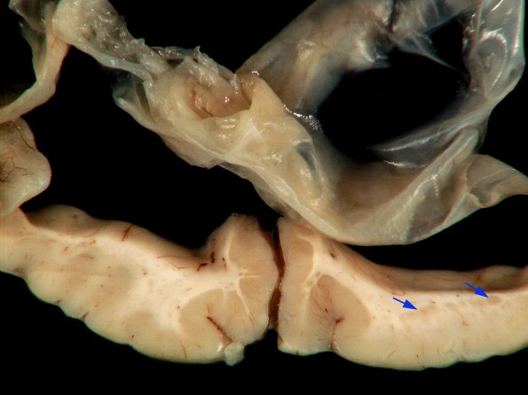 3A8 Hydranencephaly, Polyicrogyria Heterotopia (Case 3) _16A