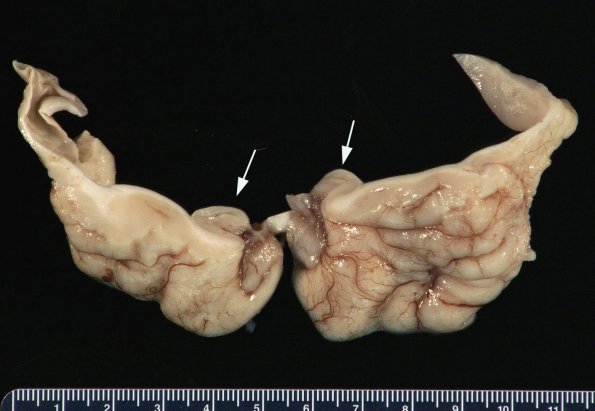 3A9 Hydranencephaly (Case 3) 10