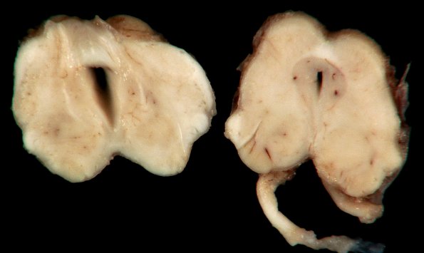 3B1 Hydranencephaly (Case 3) 14