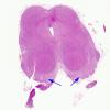 3B2 Hydranencephaly (Case 3) midbrain H&E