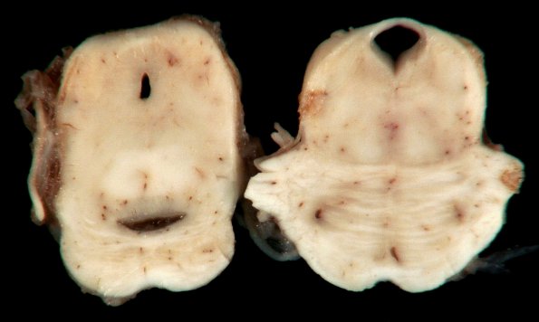 3C1 Hydranencephaly (Case 3) 15A