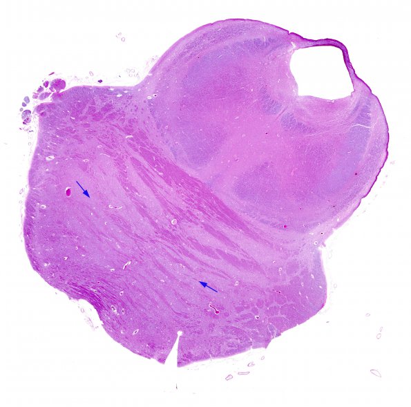 3C2 Hydranencephaly (Case 3) 15