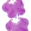 3D2 Hydranencephaly (Case 3) medulla H&E whole mount