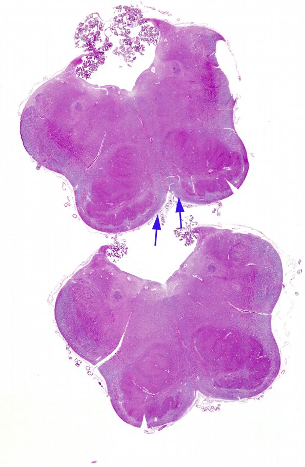 3D2 Hydranencephaly (Case 3) medulla H&E whole mount