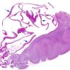 3D3 Hydranencephaly (Case 3) N14 H&E