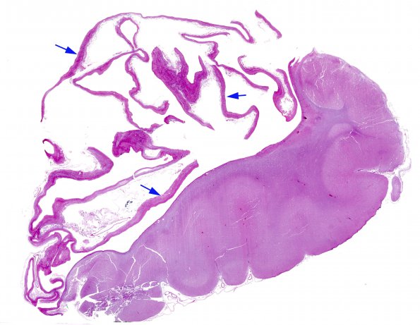 3D3 Hydranencephaly (Case 3) N14 H&E