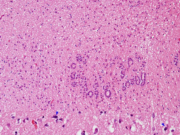 3E3 Hydranencephaly (Case 3) N14 H&E 5