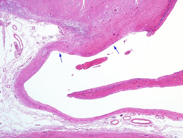 3E4 Hydranencephaly (Case 3) N14 H&E 1