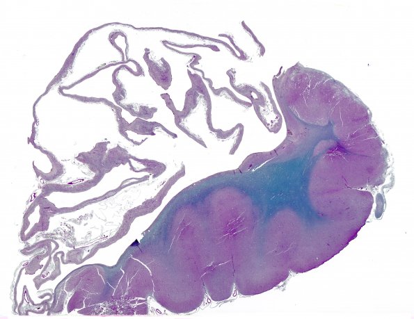 3E6 Hydranencephaly (Case 3) N14 LFB-PAS whole mount