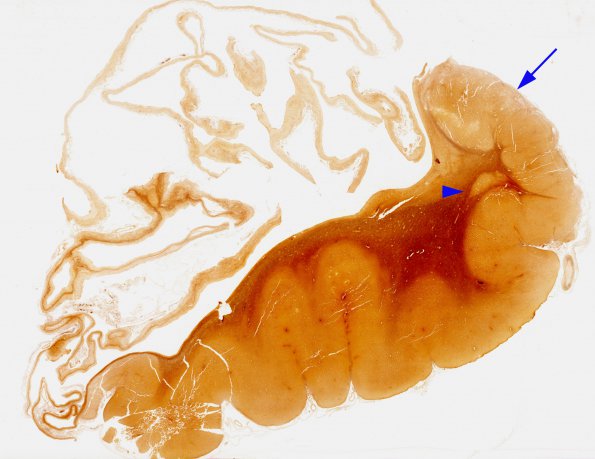 3F1 Hydranencephaly (Case 3) N14 Biels whole mount