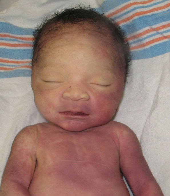 4A1 Hydranencephaly (Case 4) 1