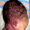 4A2 Hydranencephaly (Case 4) 2